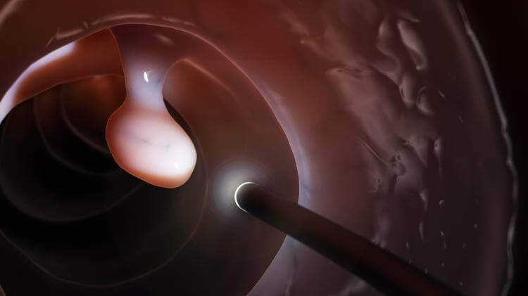 os polipos sao alteracoes na mucosa do intestino - Após retirar pólipo pré-canceroso, Will Smith fala sobre a importância da colonoscopia.