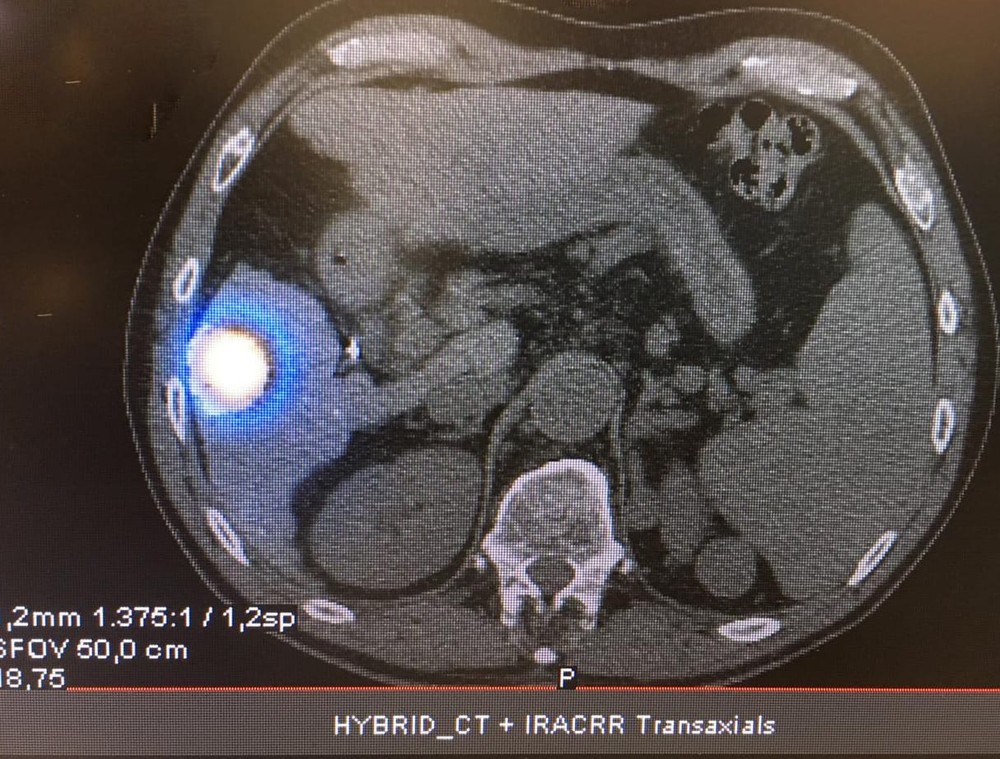 sensivel-mente.com - Um novo procedimento reduz em quase 80% tumor de paciente em hospital de SP: ‘Quebrando barreira’, diz médico