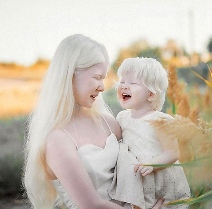10 1 - Irmãs albinas surpreendem o mundo com sua beleza extraordinária