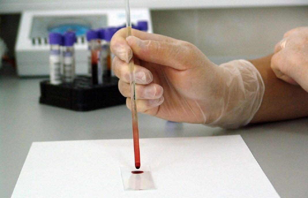Novo exame de sangue para detectar câncer de próstata com precisão de 99%