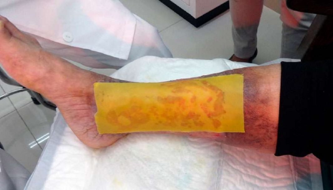 Adesivo feito com mel para diabéticos consegue regenerar a pele em 21 dias: Gratuito