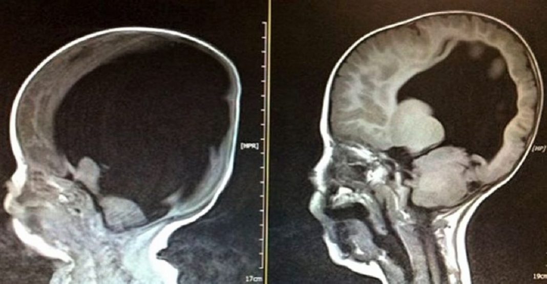 Uma varredura cerebral revelou que um estudante universitário não tinha cérebro.