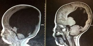 Uma varredura cerebral revelou que um estudante universitário não tinha cérebro.