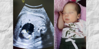 Uma bebê nasceu “grávida” na Colômbia. Compreenda o caso!