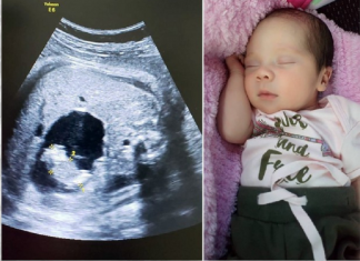 Uma bebê nasceu “grávida” na Colômbia. Compreenda o caso!