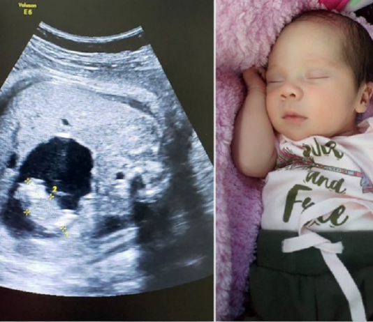 Uma bebê nasceu “grávida” na Colômbia. Compreenda o caso!