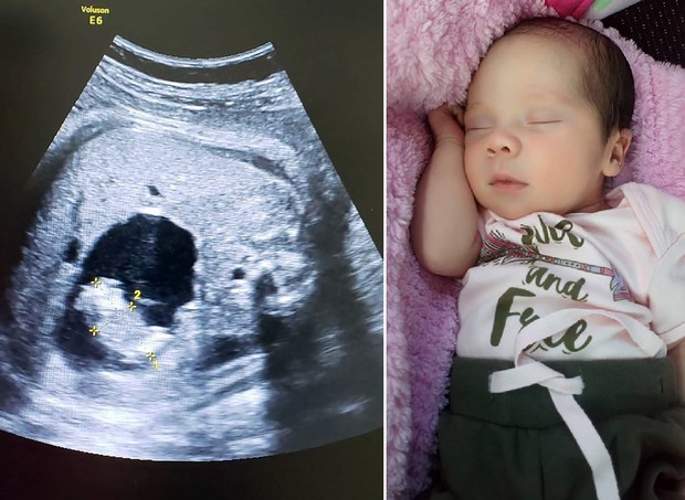 ultrassom - Uma bebê nasceu “grávida” na Colômbia. Compreenda o caso!