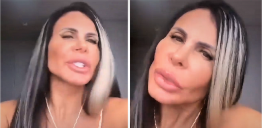Gretchen ficou irada com as críticas feitas à sua harmonização facial: ”Povinho recalcado”