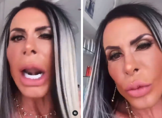 Gretchen mostra o resultado final de seu rosto uma semana após a “harmonização Facial”- (vídeo)