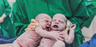 Imagens de gêmeas se abraçando após o parto em SC encanta os internautas