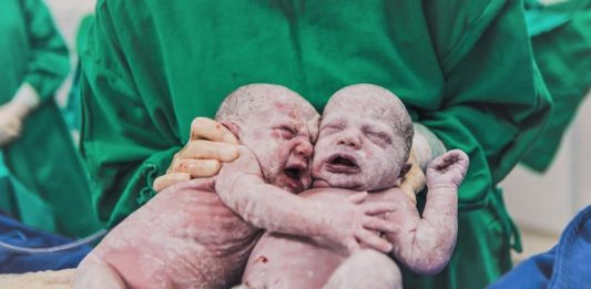 Imagens de gêmeas se abraçando após o parto em SC encanta os internautas