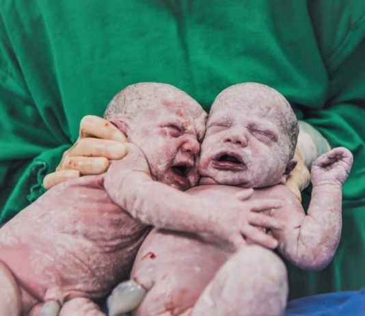 Imagens de gêmeas se abraçando após o parto em SC encanta os internautas