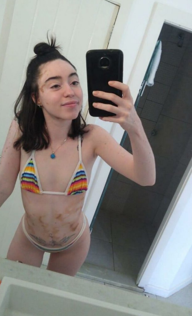 sensivel-mente.com - Jovem com vitiligo usou a modelagem para superar a baixa autoestima. Agora admire sua beleza