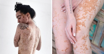 Captura de Tela 378 - Jovem com vitiligo usou a modelagem para superar a baixa autoestima. Agora admire sua beleza