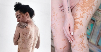 sensivel-mente.com - Jovem com vitiligo usou a modelagem para superar a baixa autoestima. Agora admire sua beleza