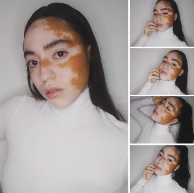 Captura de Tela 379 - Jovem com vitiligo usou a modelagem para superar a baixa autoestima. Agora admire sua beleza