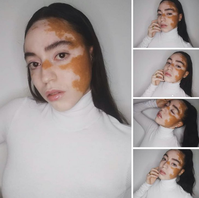 sensivel-mente.com - Jovem com vitiligo usou a modelagem para superar a baixa autoestima. Agora admire sua beleza