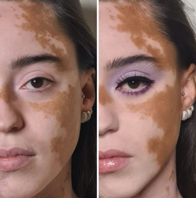 Captura de Tela 380 - Jovem com vitiligo usou a modelagem para superar a baixa autoestima. Agora admire sua beleza
