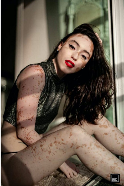 Captura de Tela 382 - Jovem com vitiligo usou a modelagem para superar a baixa autoestima. Agora admire sua beleza