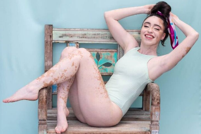 sensivel-mente.com - Jovem com vitiligo usou a modelagem para superar a baixa autoestima. Agora admire sua beleza