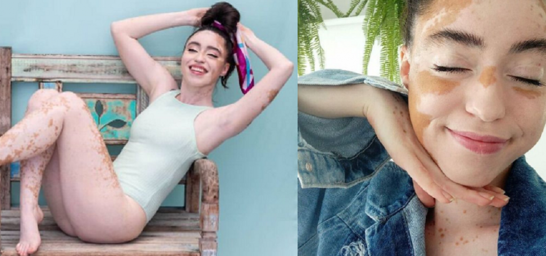 Jovem com vitiligo usou a modelagem para superar a baixa autoestima. Agora admire sua beleza