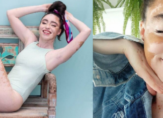 Jovem com vitiligo usou a modelagem para superar a baixa autoestima. Agora admire sua beleza