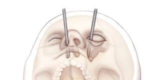 Cirurgia inédita: médicos salvam jovem de 19 anos operando o cérebro pelos olhos!
