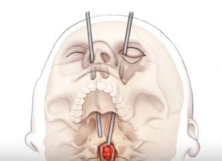 Cirurgia inédita: médicos salvam jovem de 19 anos operando o cérebro pelos olhos! Cirurgia inédita: médicos salvam jovem de 19 anos operando o cérebro pelos olhos!