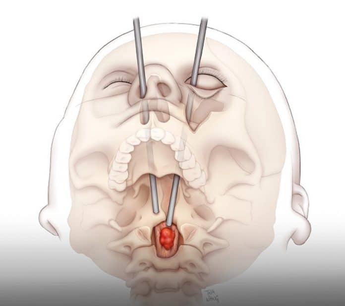 Cirurgia inédita: médicos salvam jovem de 19 anos operando o cérebro pelos olhos!